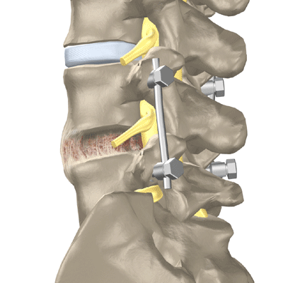 Lumbar Fracture Fixation - Lower Back - Surgery - What We Treat 